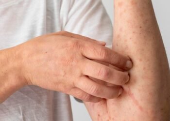 Mpox: prevenção e cuidados essenciais