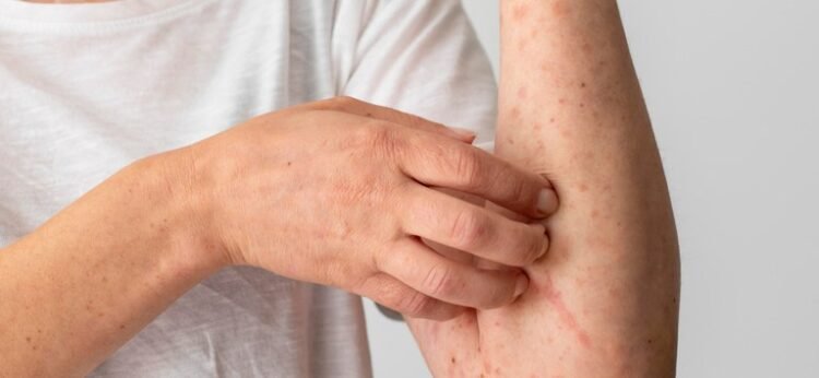 Mpox: prevenção e cuidados essenciais